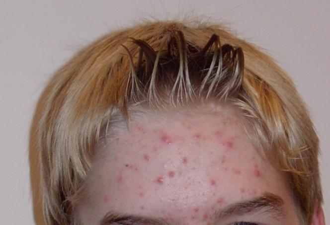 Roaccutane en ligne