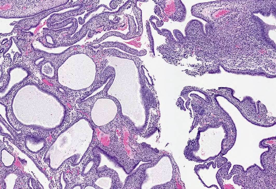 tamoxifen pilules tamoxifen pilules