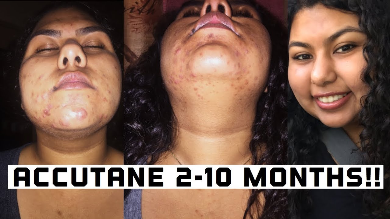 accutane online italia