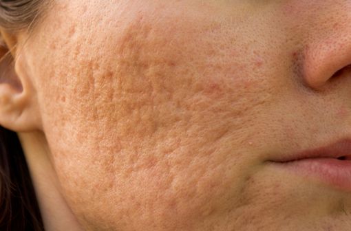 Pilule Contre Roaccutane