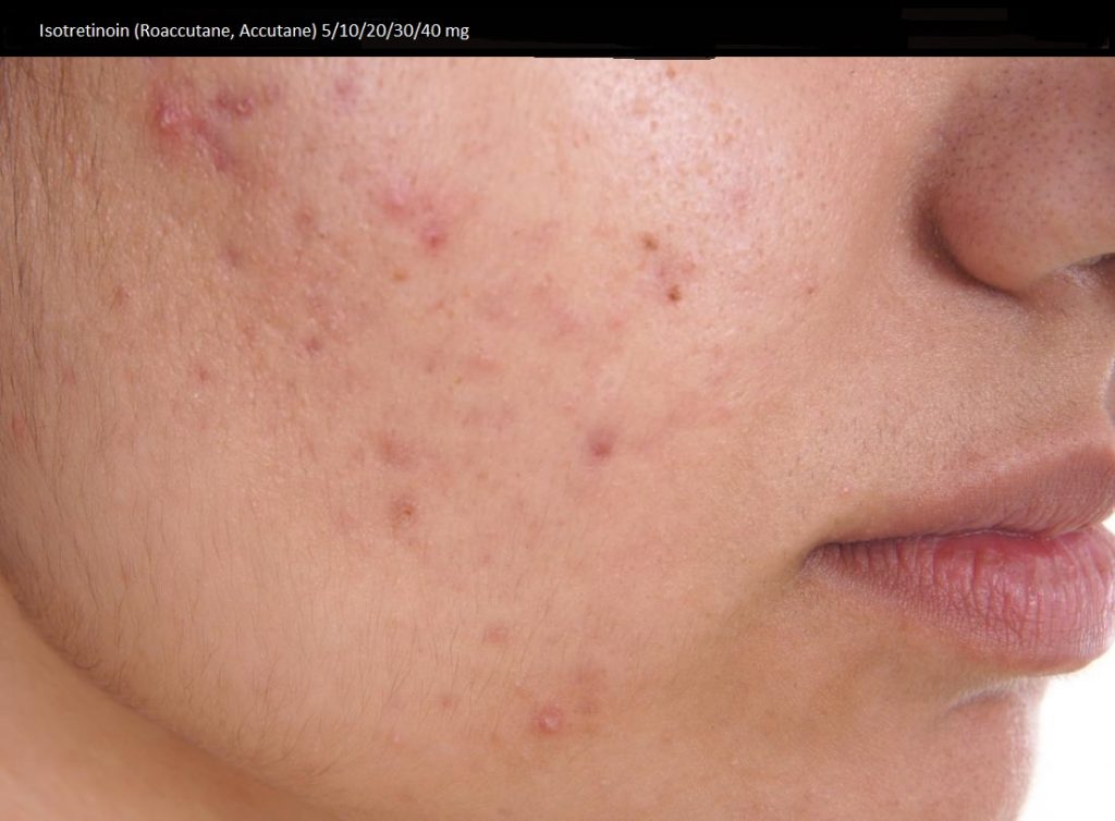 Isotretinoin bnf online Isotretinoin bnf online