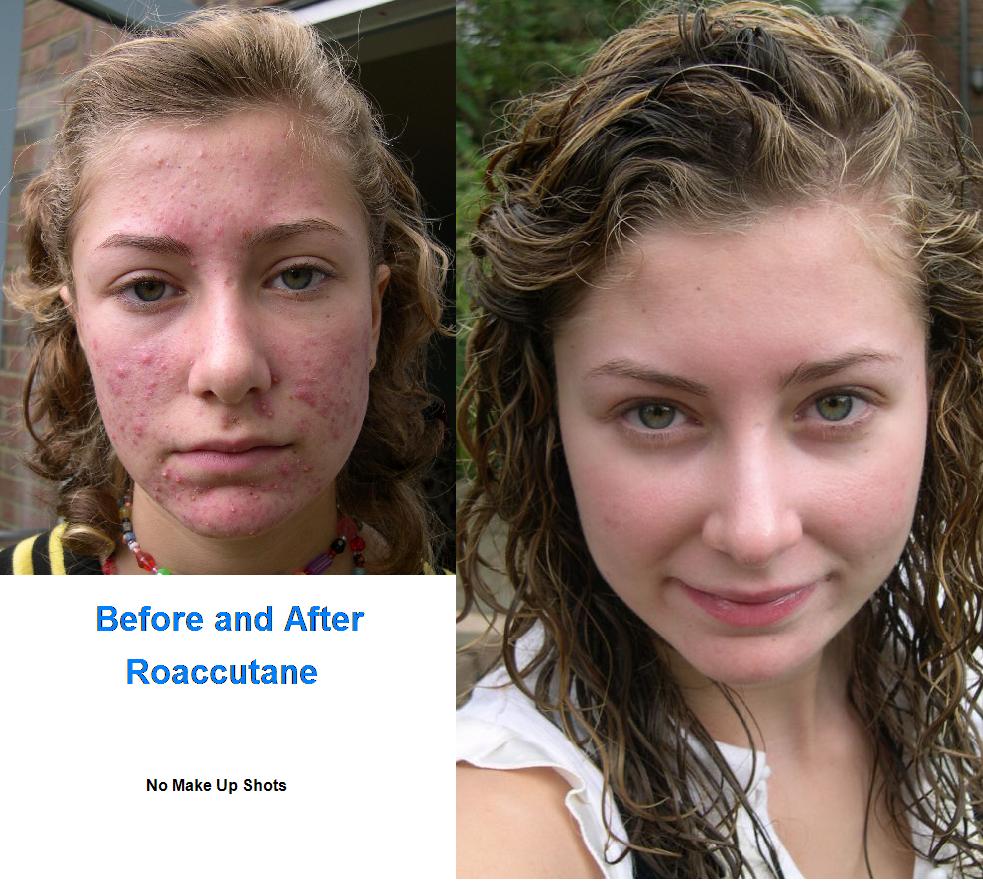 Commander du roaccutane