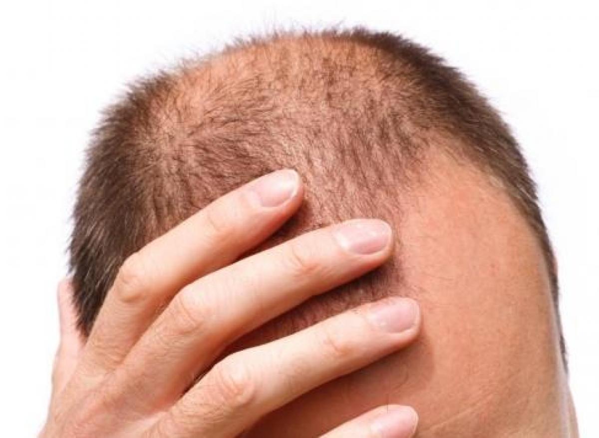 finasteride en france Finasteride en france
