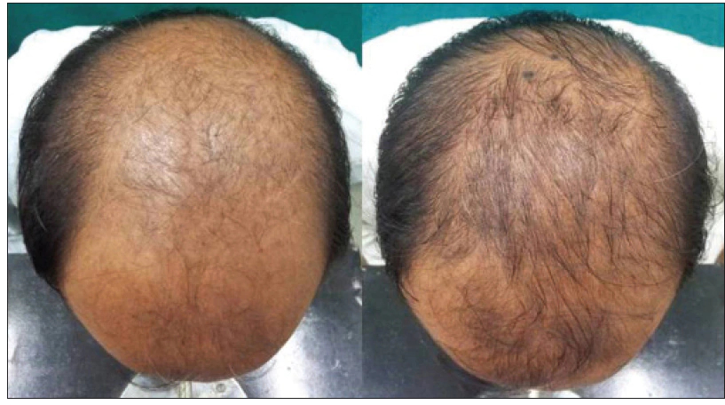 le prix finasteride