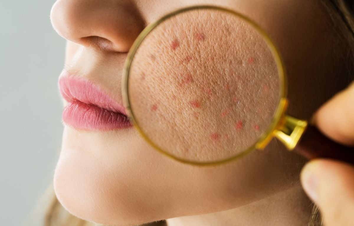 roaccutane pilule obligatoire