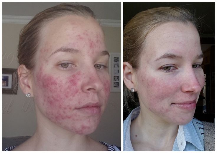 Où acheter du accutane