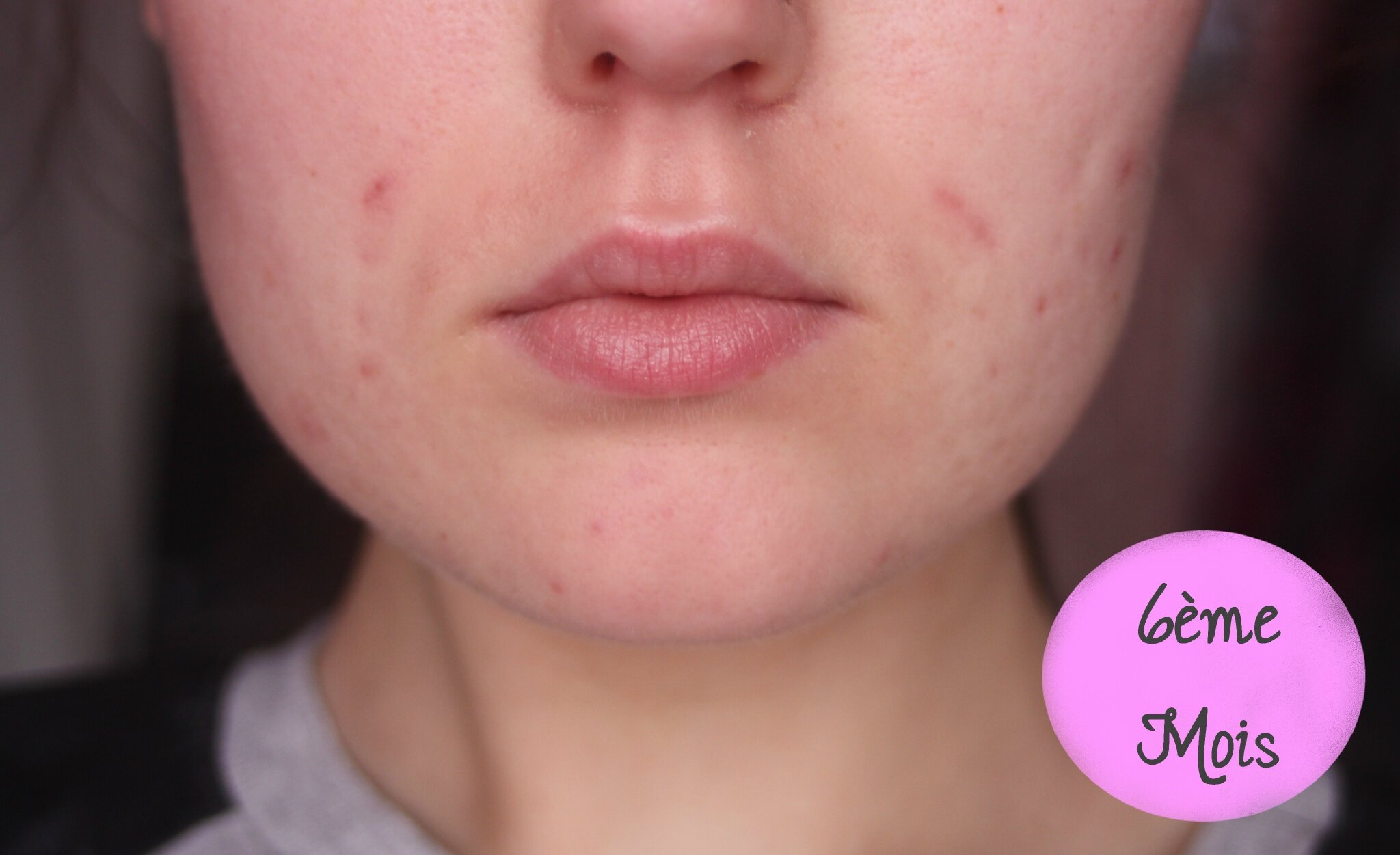 Roaccutane pilule du lendemain