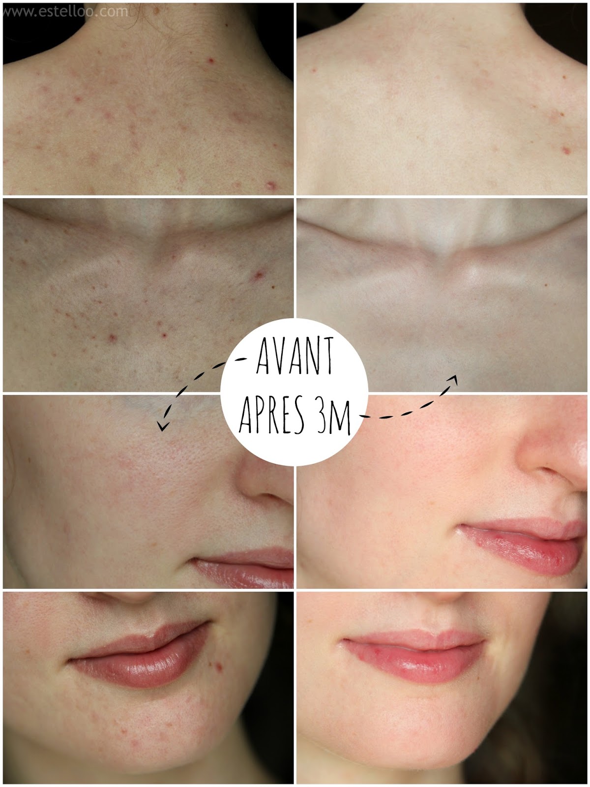 roaccutane quelle pilule roaccutane quelle pilule