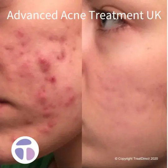 Accutane Pharmacie Online
