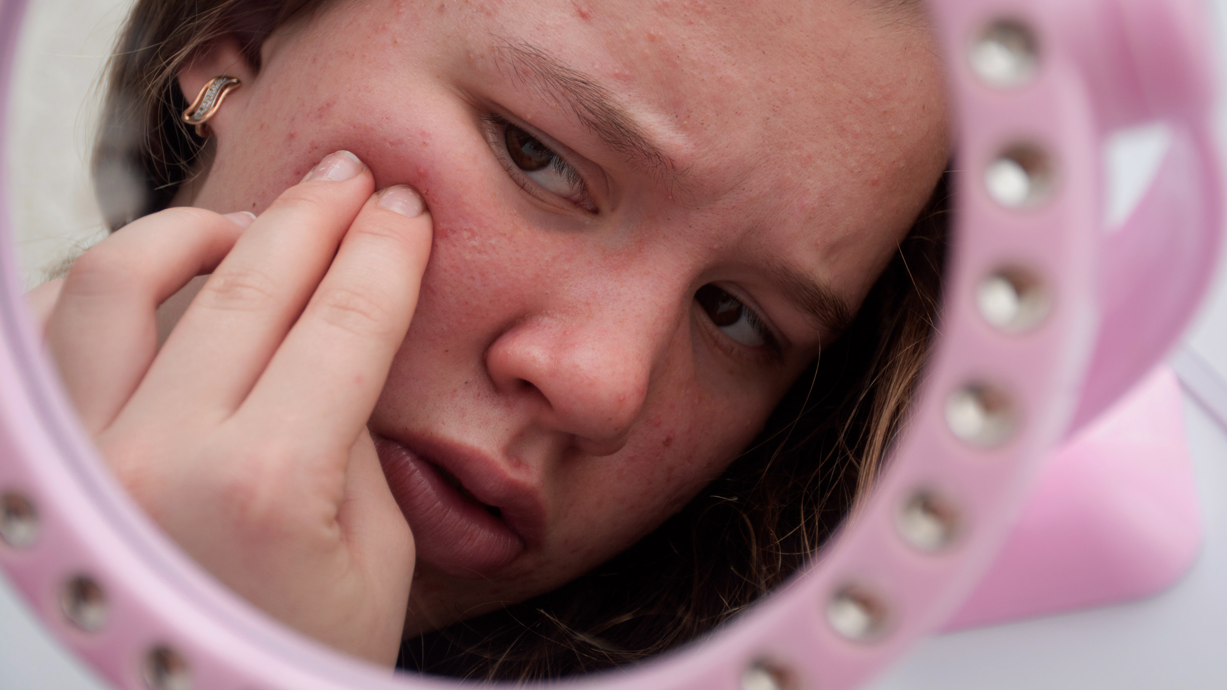 Roaccutane Prix Acné