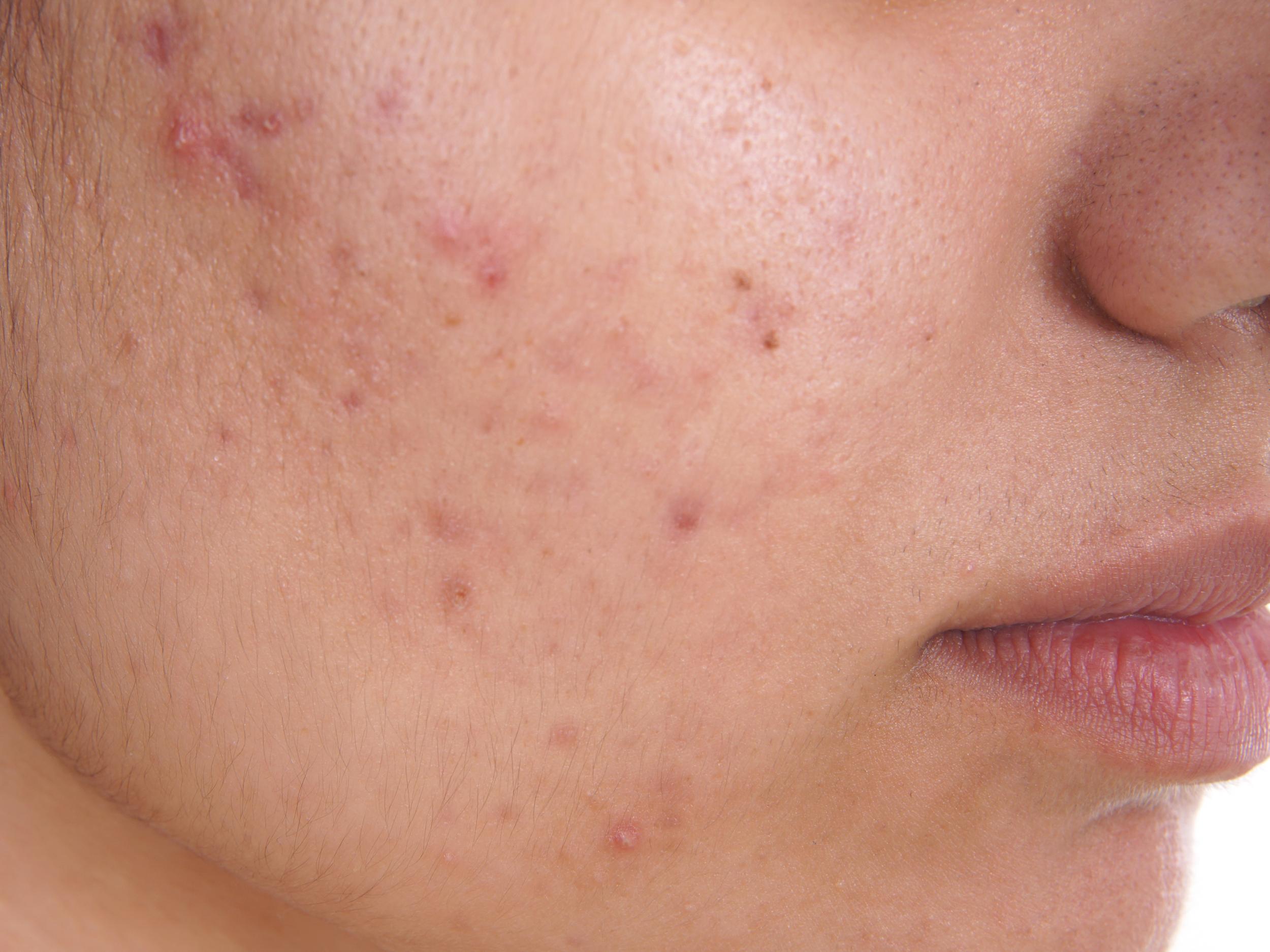 accutane 10mg