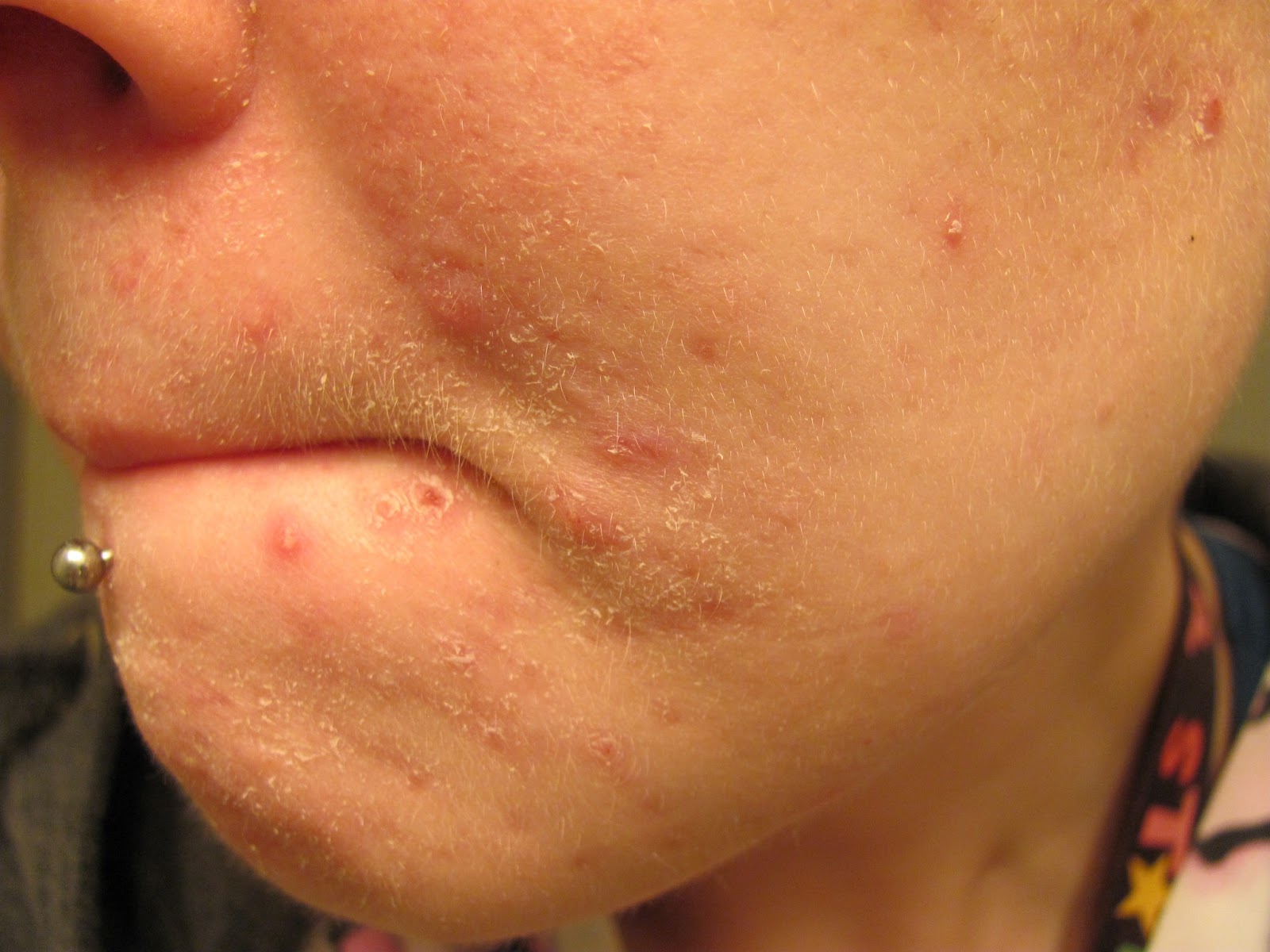 Accutane 40mg