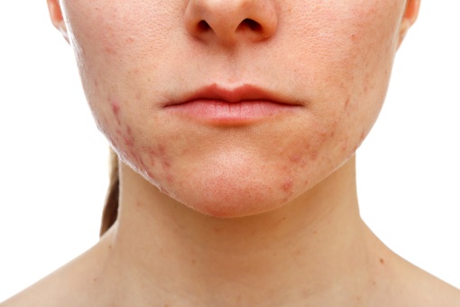 Accutane Achat France