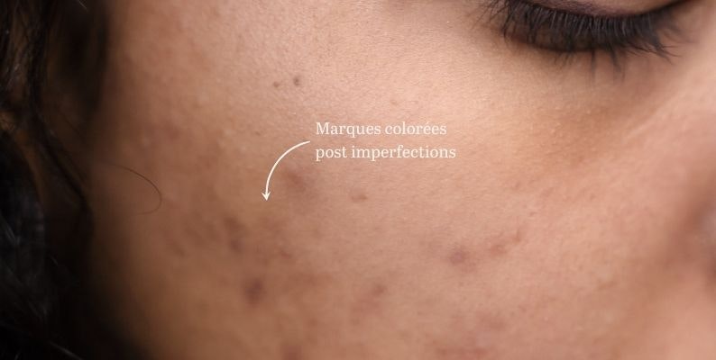 accutane acheter sans ordonnance