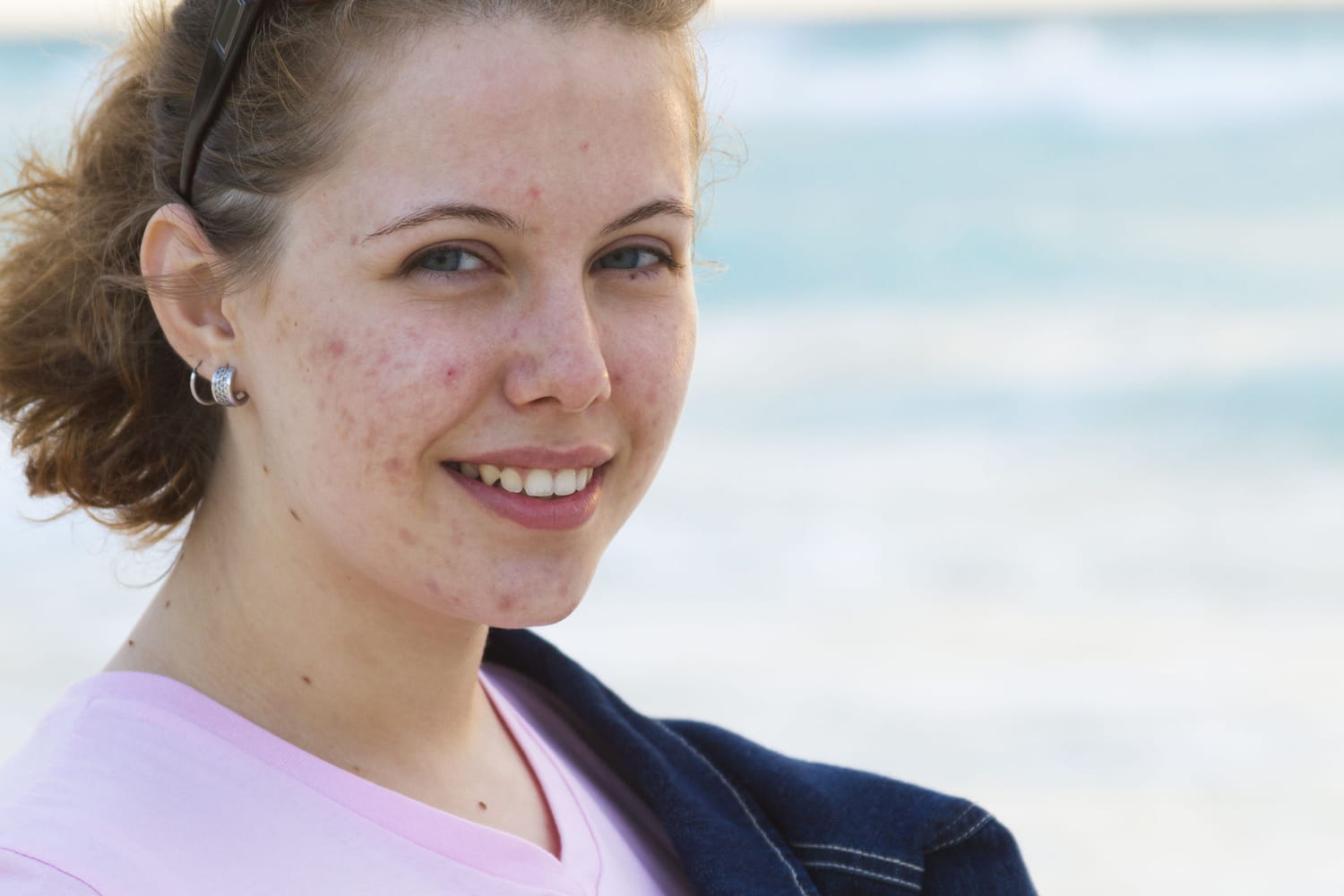 Achat roaccutane en ligne
