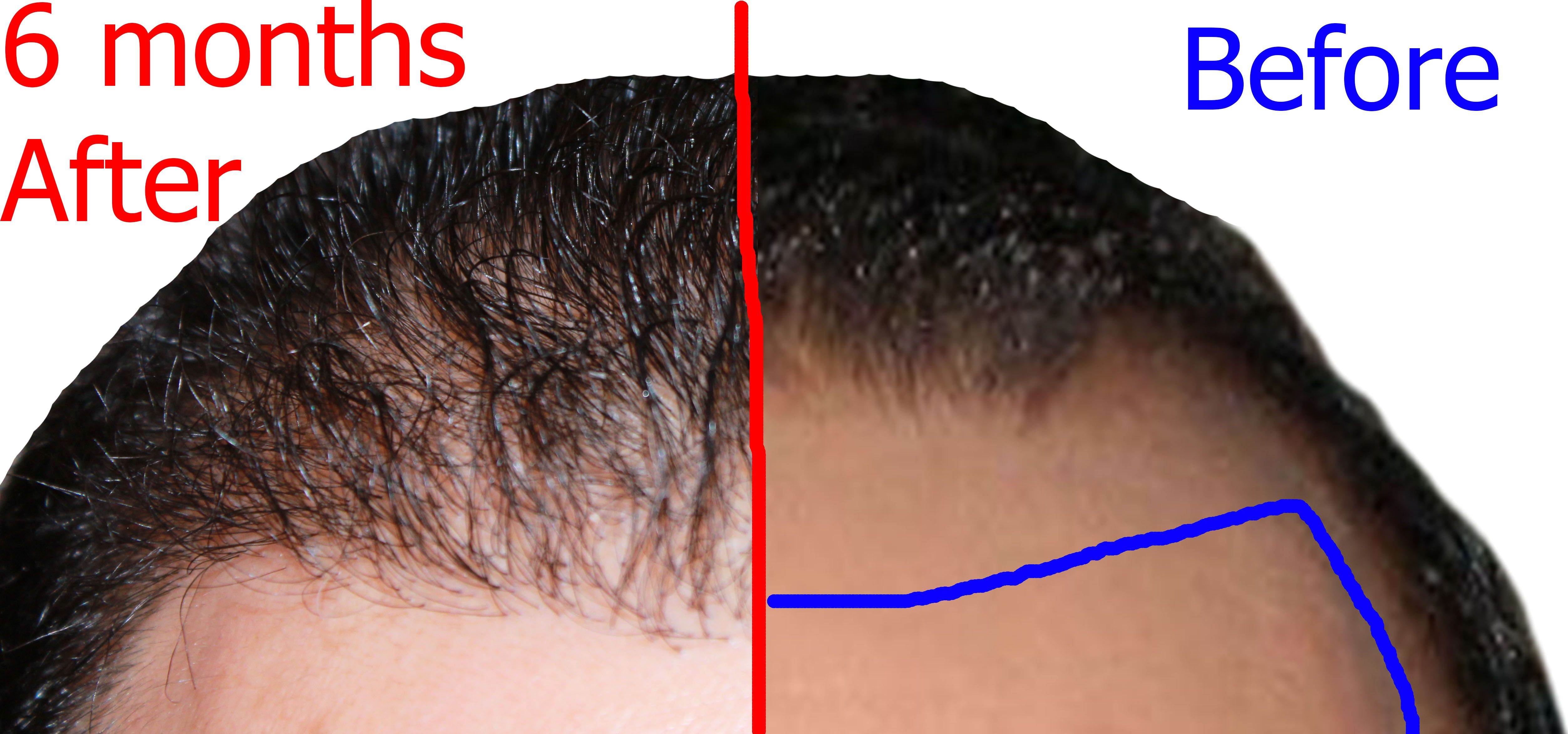 Acheter de la finasteride