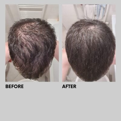 Ou Acheter Finasteride Gel Ou acheter finasteride gel