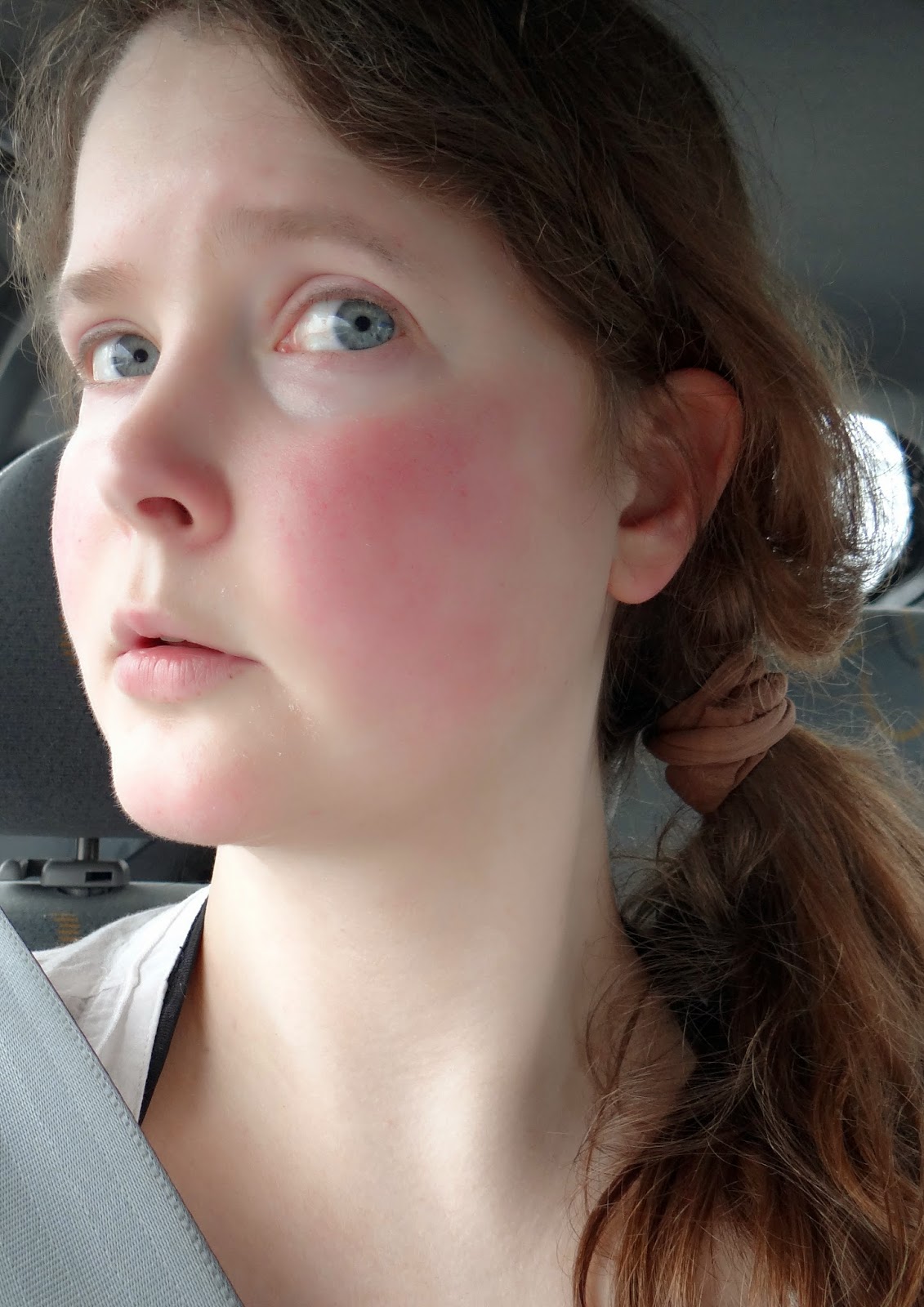 Accutane 30mg