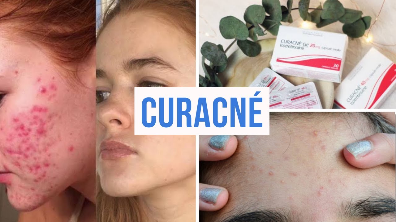 Prix roaccutane france