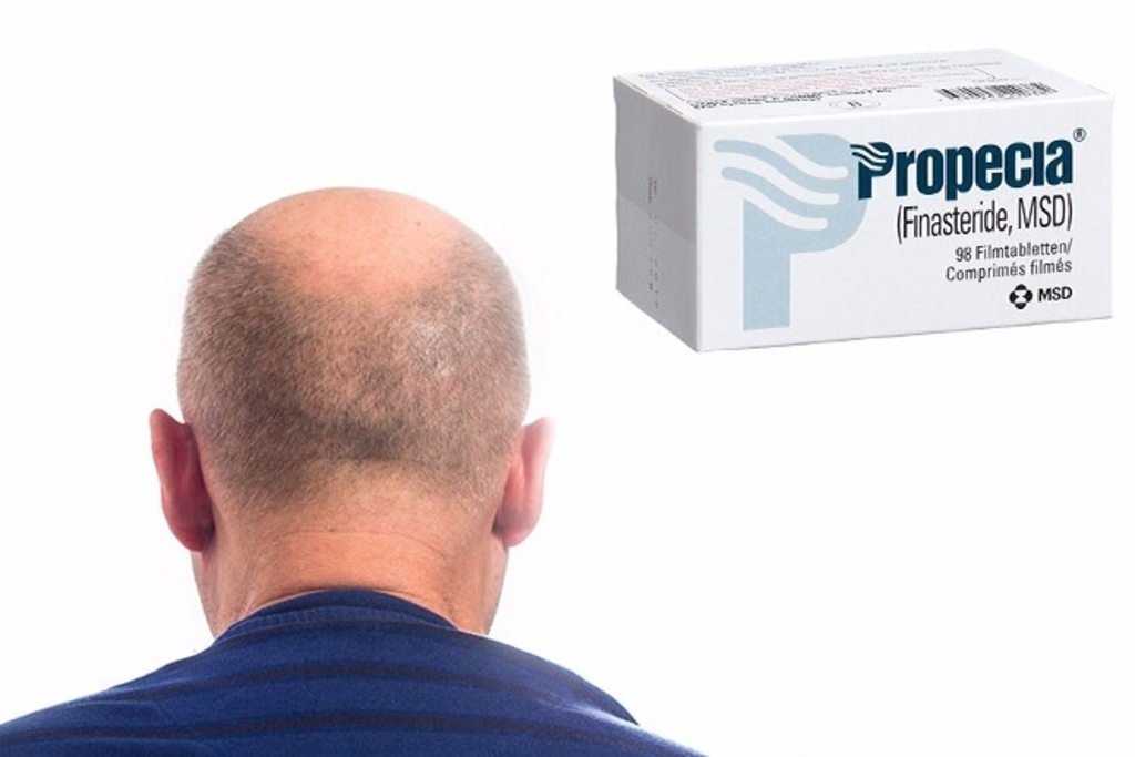 Acheter finasteride gel