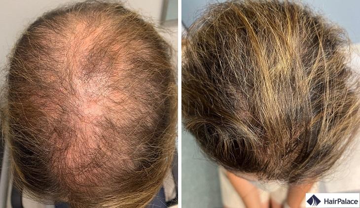 acheter du finasteride