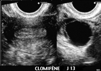 Clomid 100mg pas dovulation