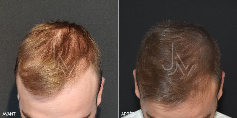 Coût Du Finasteride