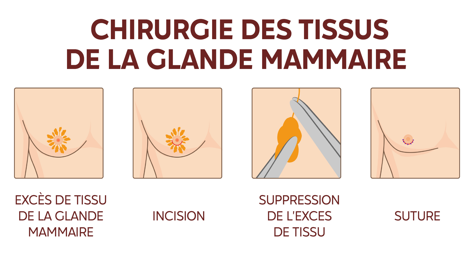 Coût Tamoxifène Coût Tamoxifène