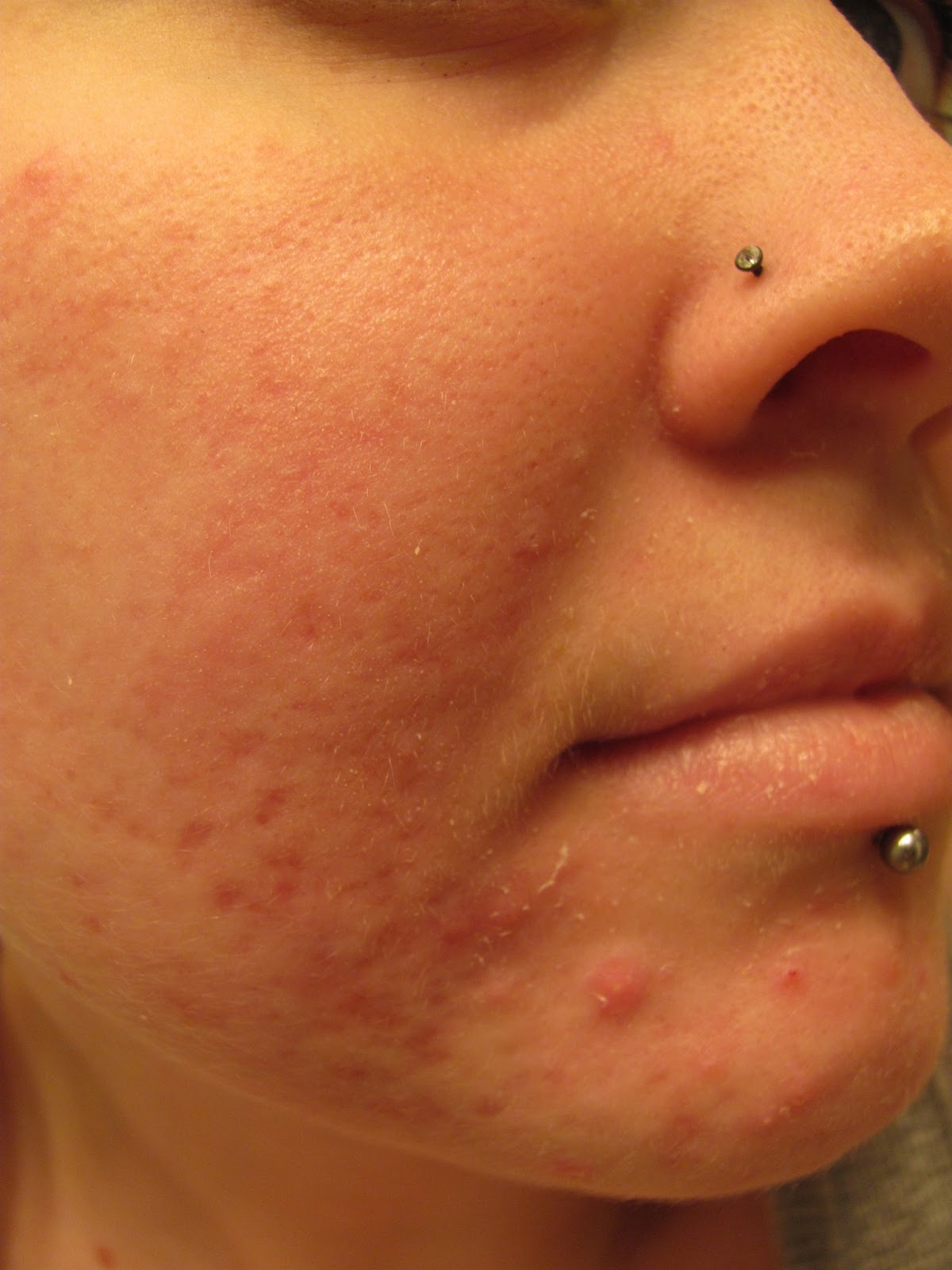 Accutane 5mg