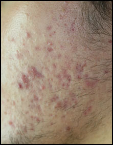 Doxycycline acné prix