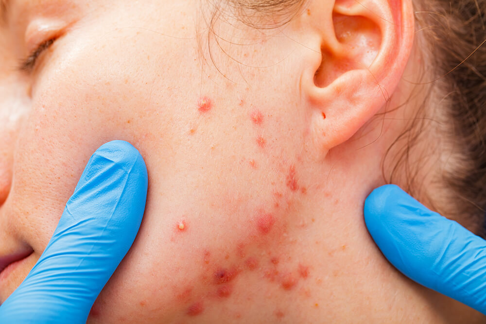 Accutane Acheter Online