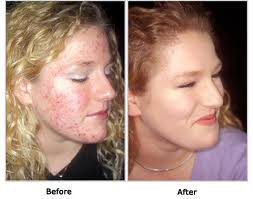Roaccutane ou pilule