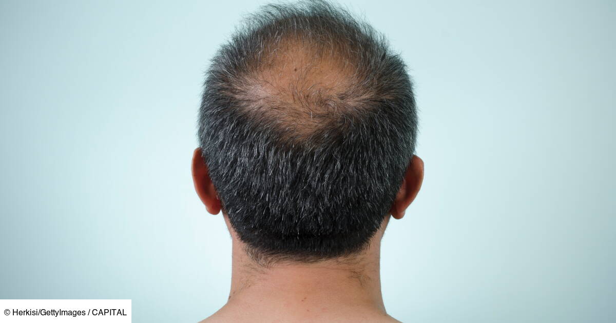 finasteride 5mg cheveux prix