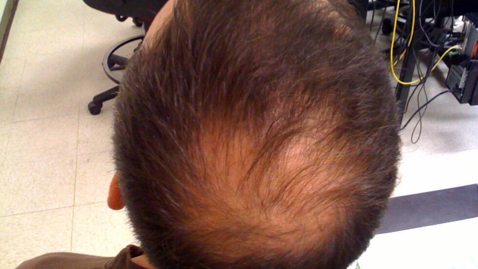 Finasteride france acheter