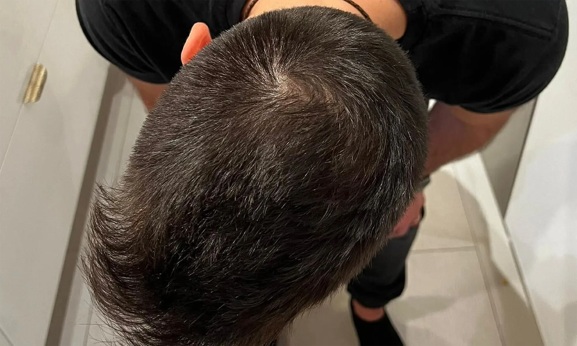 Finasteride gel online