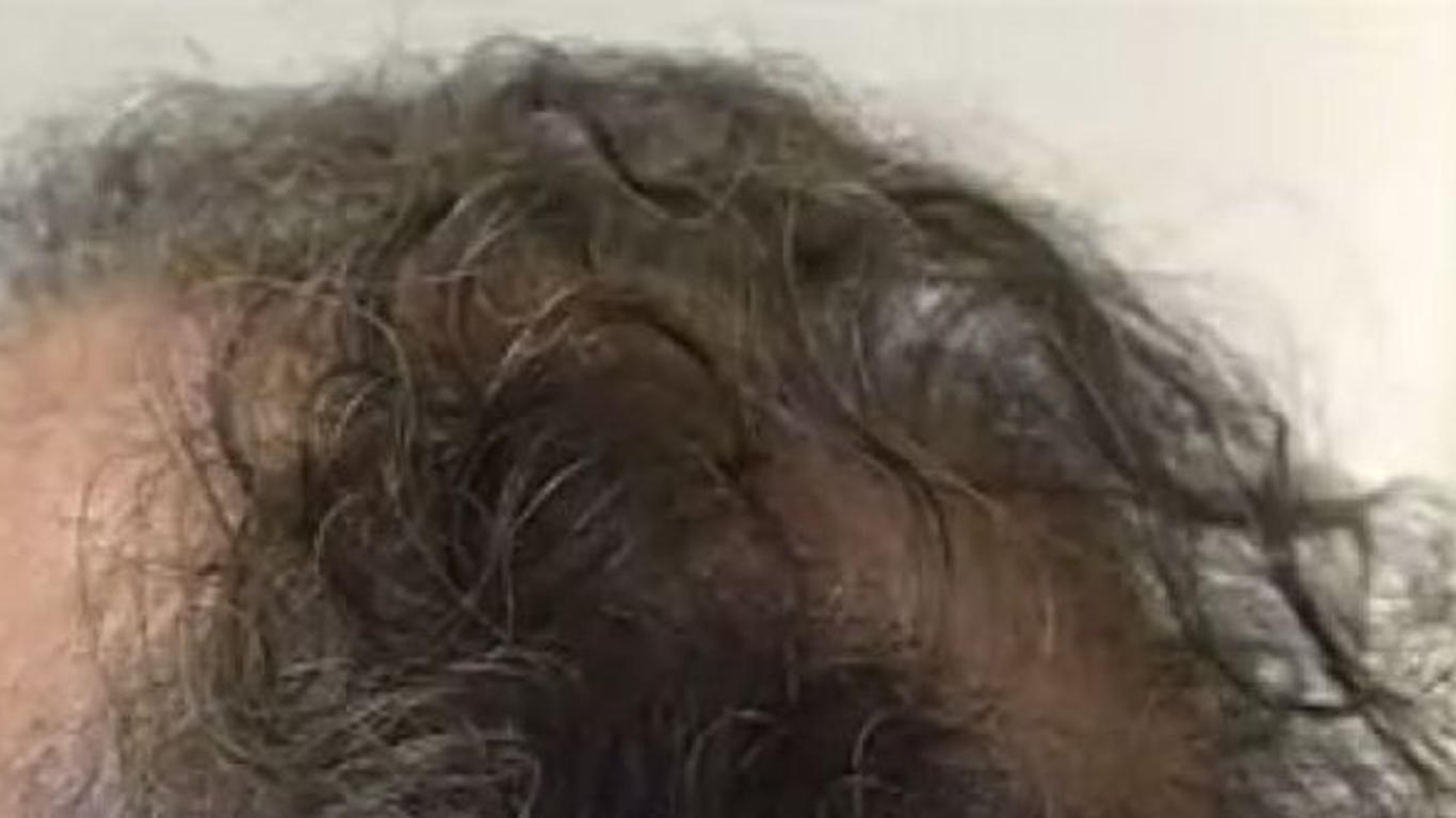 Finasteride générique prix Finasteride Générique Prix