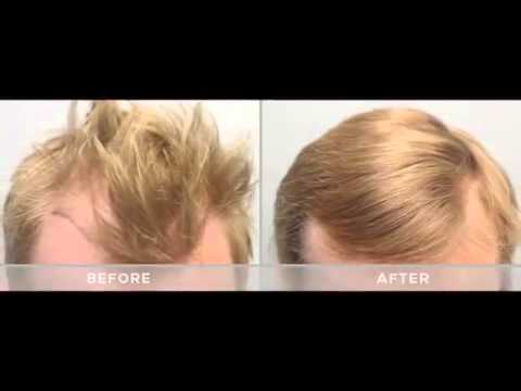 Finasteride où acheter