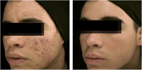 Isotretinoin France