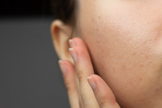 où acheter du isotretinoin