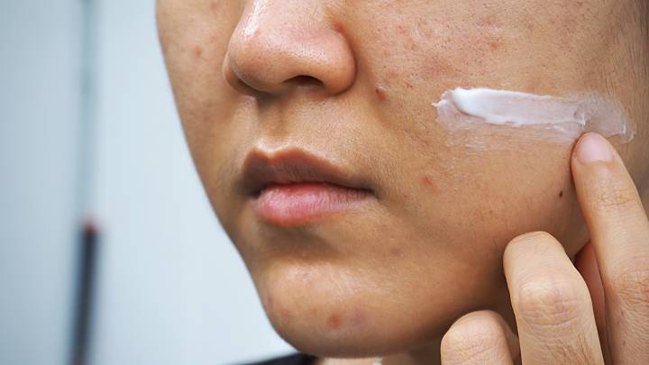 Online Dermatologist Isotretinoin