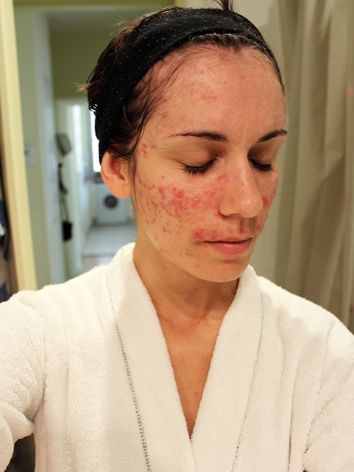 peut on avoir accutane sans ordonnance