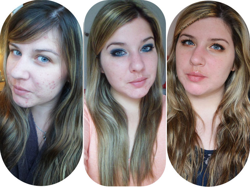 Prix de roaccutane