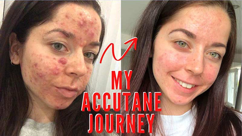 prix du accutane