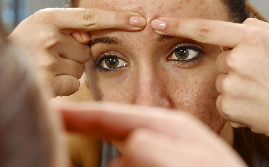 Prix pour roaccutane