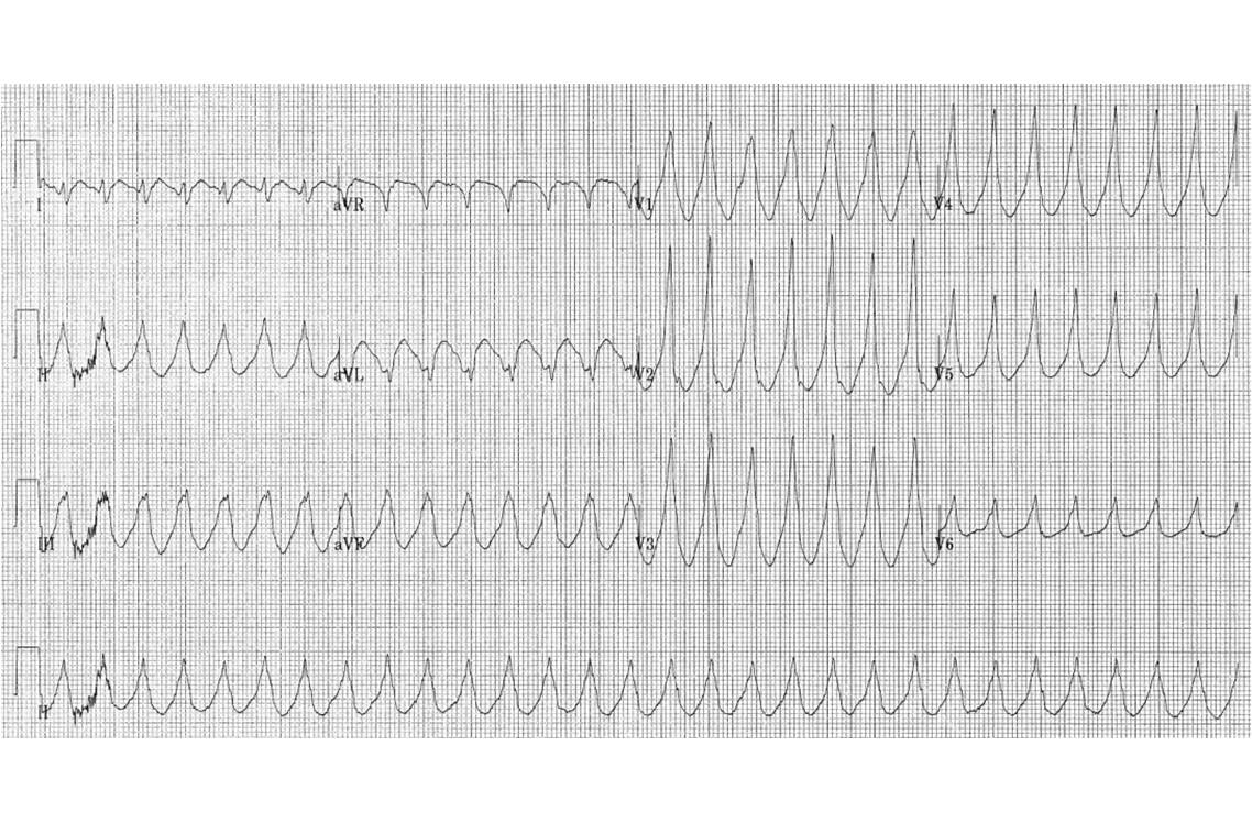 Propranolol france