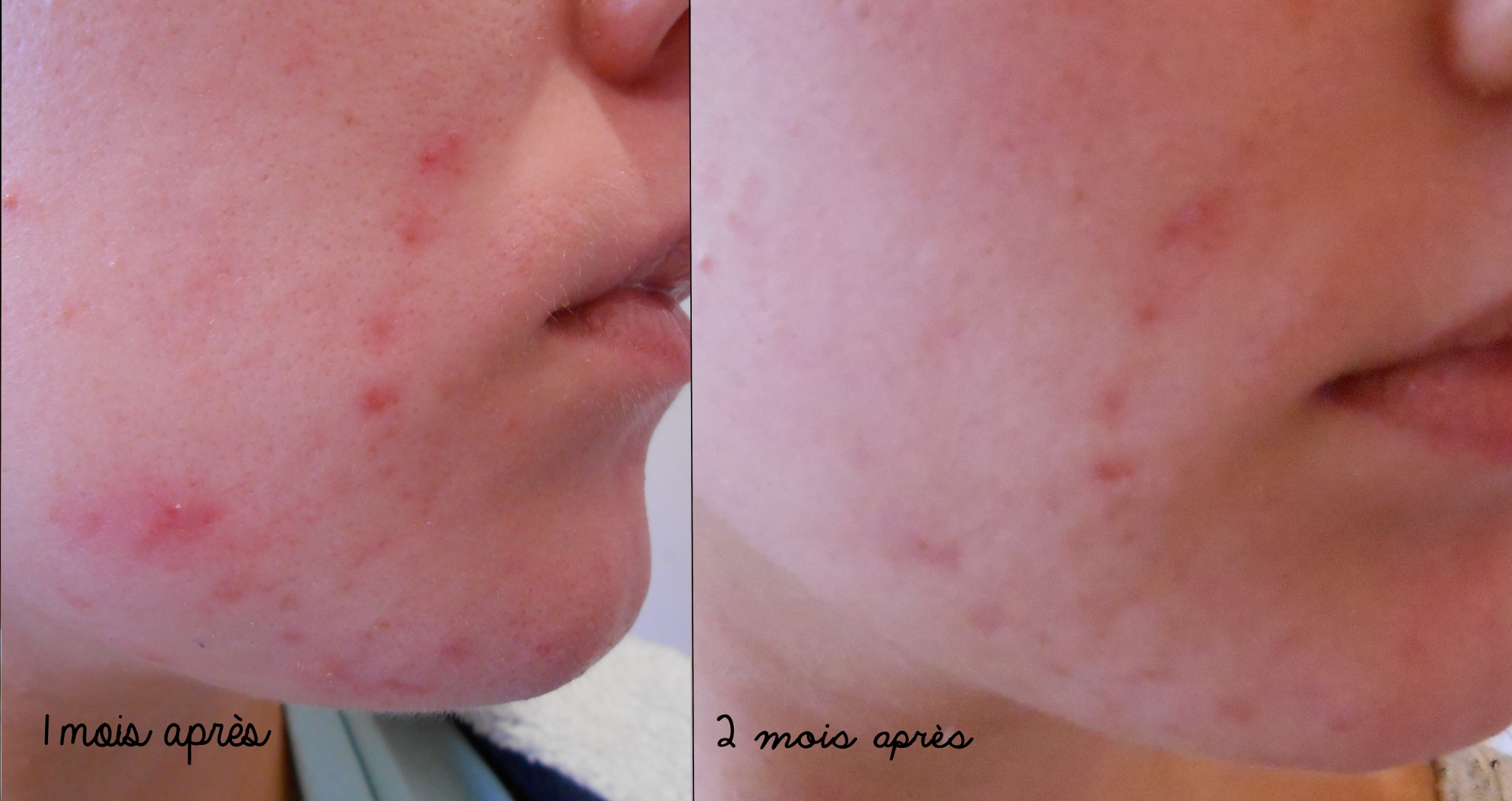 Roaccutane 30mg roaccutane 30mg