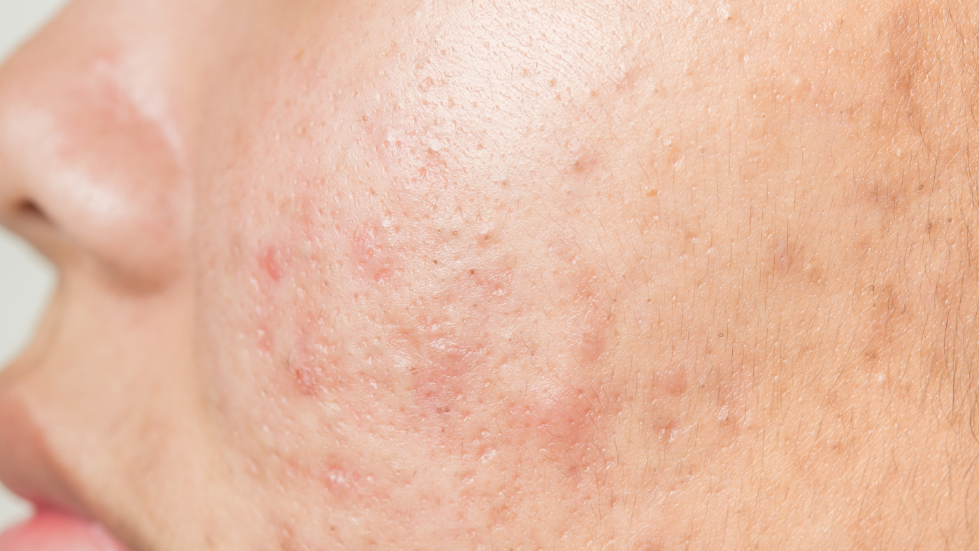 Roaccutane Gel Acheter Ligne