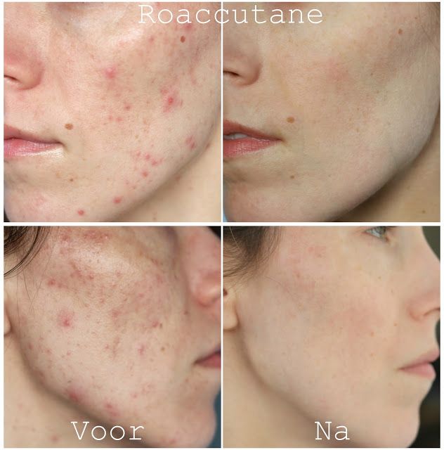 roaccutane gel france