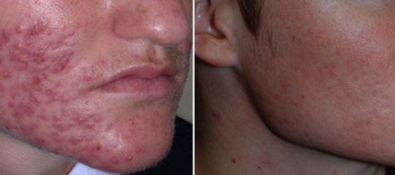 Roaccutane le moins cher