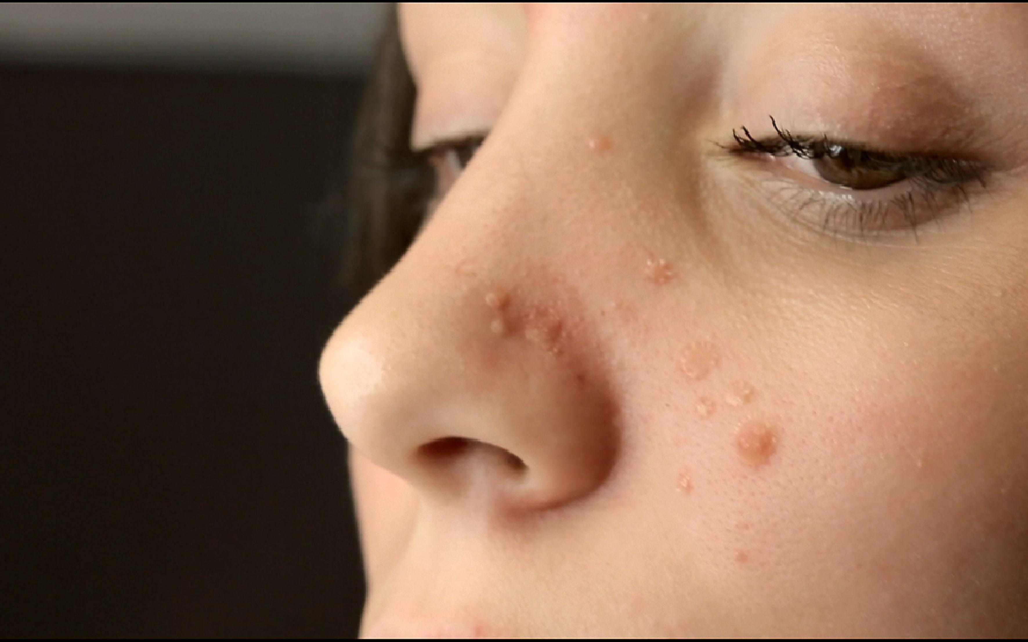 Roaccutane Pilules